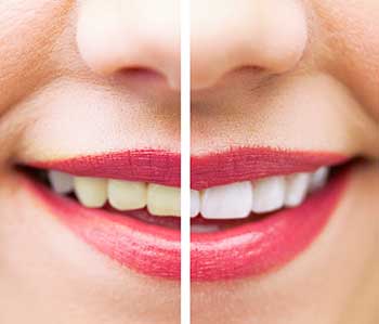 Teeth Whitening in Mint Hill