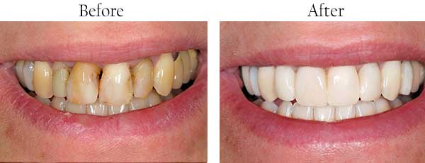 Mint Hill Before and After Teeth Whitening