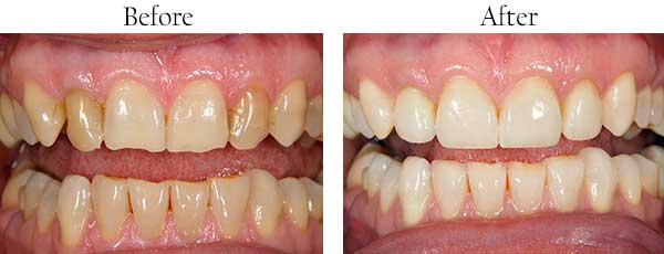 Matthews Before and After Dental Implants