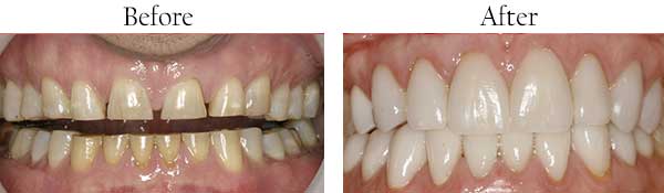 Mint Hill Before and After Teeth Whitening